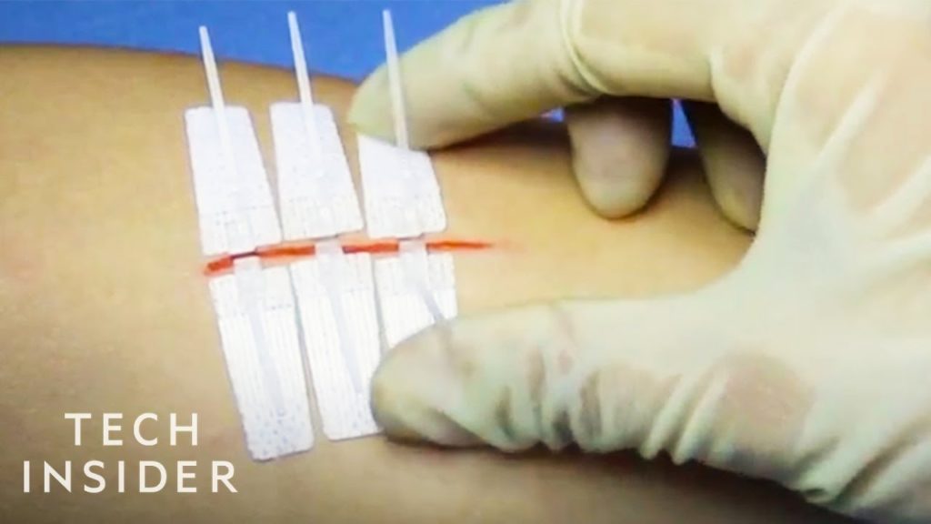 Needle-Less Alternative to Stitches