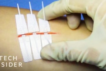 Needle-Less Alternative to Stitches