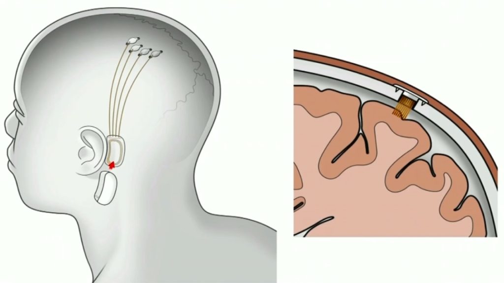 Chip allowing Brain-Computer Communication to come ‘before the end of next year’